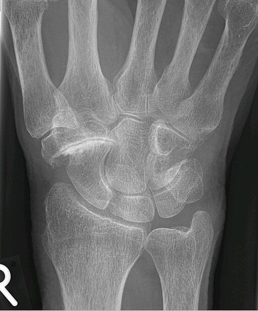 stt-arthrose STT Arthrose