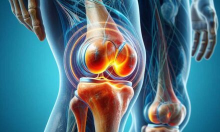 Gonarthrose: Ein umfassender Leitfaden