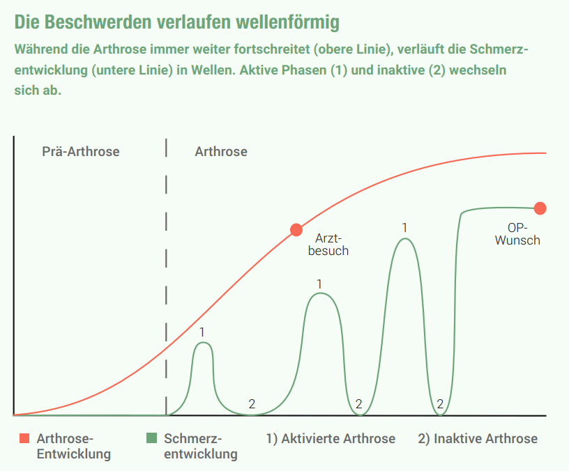Schematische Darstellung der verschiedenen Phasen der Arthrose.